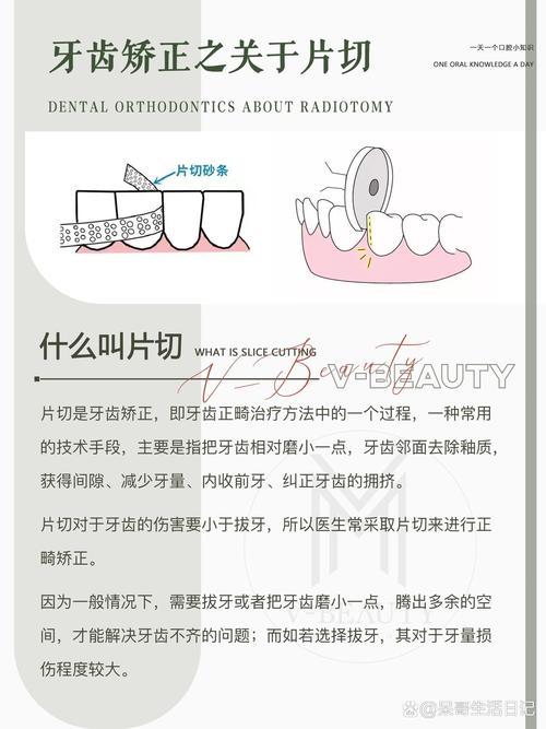 正畸片切需要多长时间完成？-图2