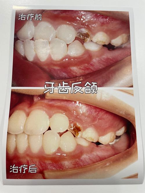 正畸后一颗尖牙老不动-图3