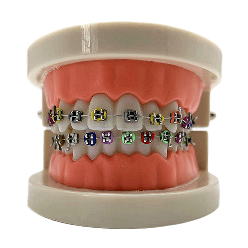 陶瓷托槽矫正最好方法-图1