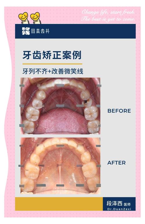 牙槽骨突出手术和正畸，该先做哪个？效果如何？-图2