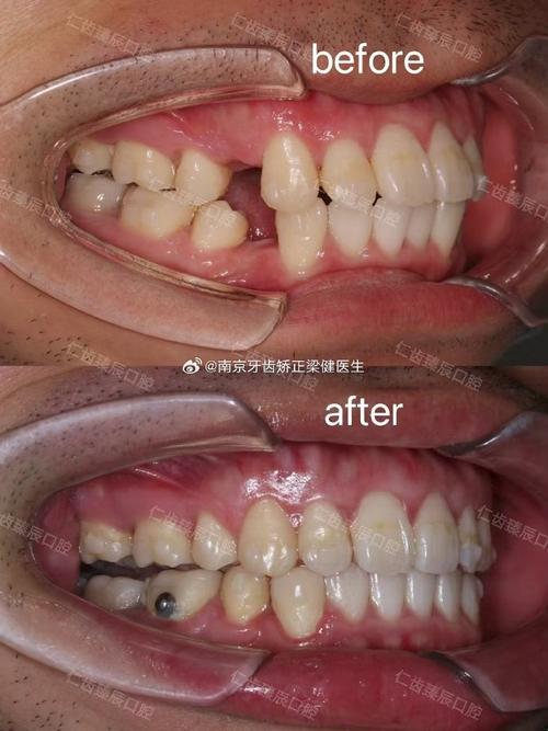 正畸拔三颗牙的原因是什么？案例图片看懂这些治疗关键点-图1