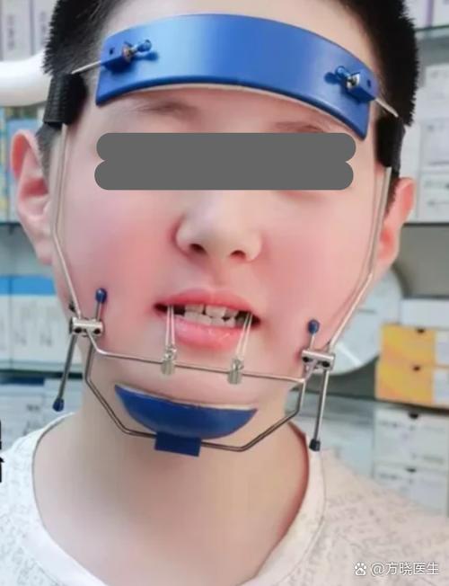 正畸前方牵引器多少钱-图1