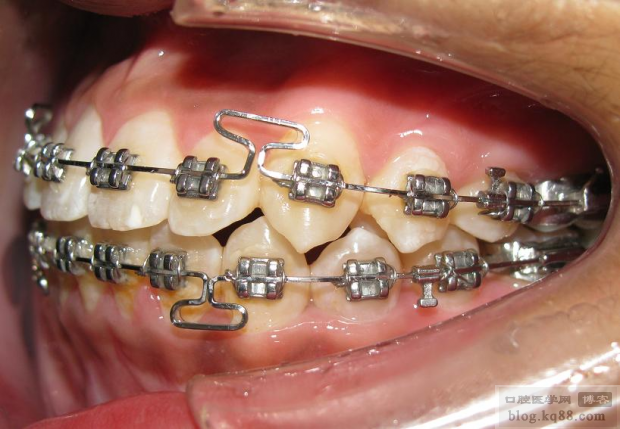 kq88口腔正畸图片-图1