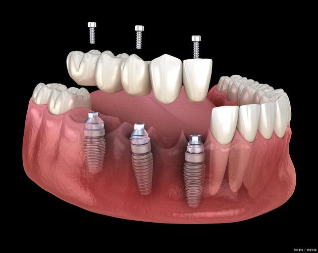 种牙术一期不良反应-图2