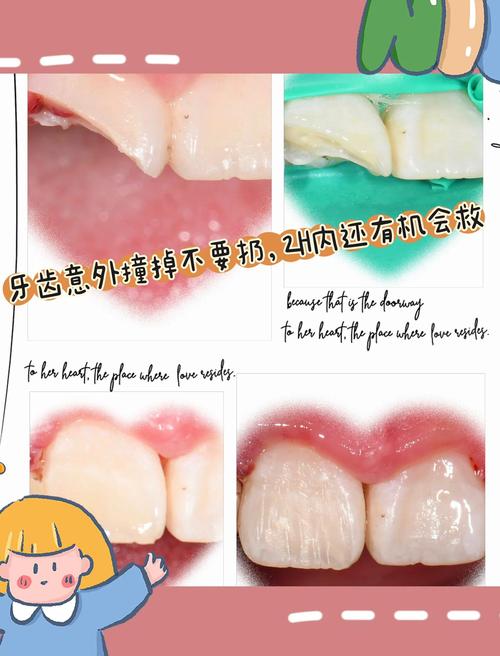 断牙修复最佳方法门牙-图1