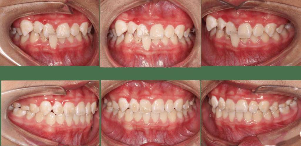 正畸时3号4号牙重叠是什么原因？-图2