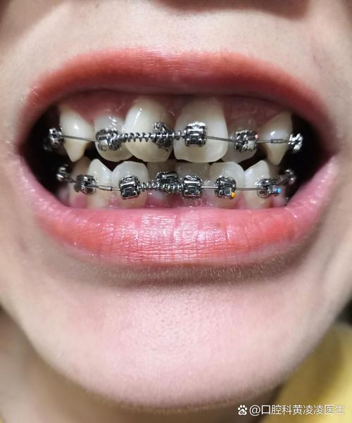 上下牙齿错位矫正有哪些常用的有效矫正方法？-图3