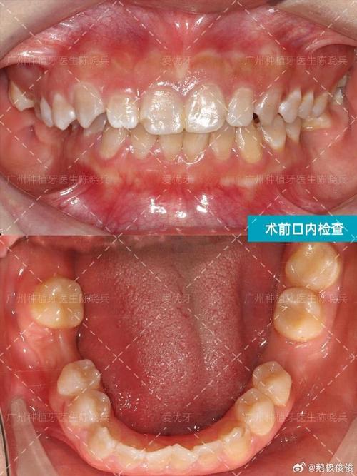 种牙一期后牙槽骨薄-图1