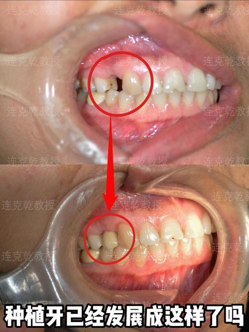 种牙一期后牙槽骨薄-图2