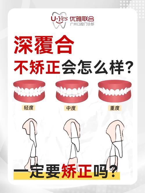 深覆合矫正有哪些方法？不同矫正方式有何区别？-图2