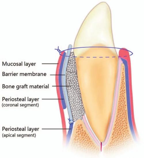 牙周加速骨源性正畸学-图1