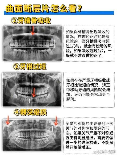 牙周加速骨源性正畸学-图2