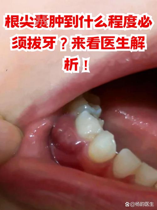 牙根尖脓肿的治疗方法-图1