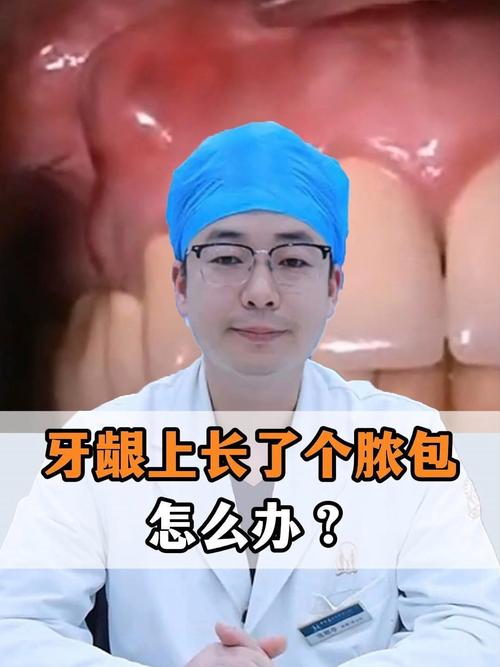 牙根尖脓肿的治疗方法-图2