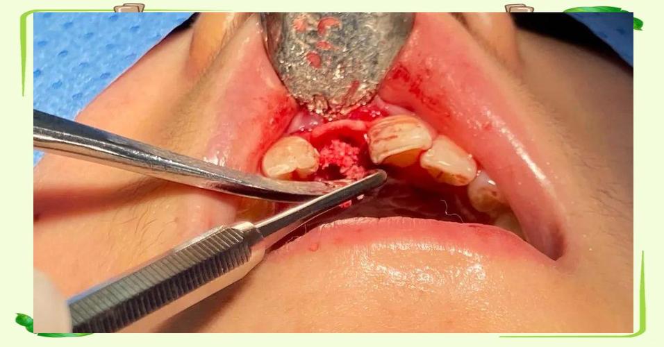 牙根尖脓肿的治疗方法-图3