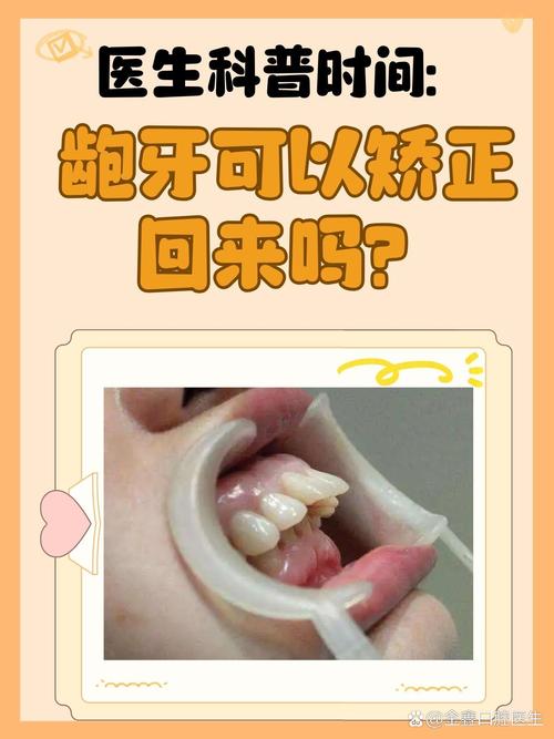 正畸过程中牙齿会龅吗-图1