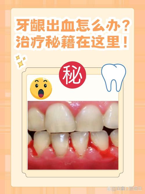 牙龈出血怎么治？专业治疗方法有哪些？-图3