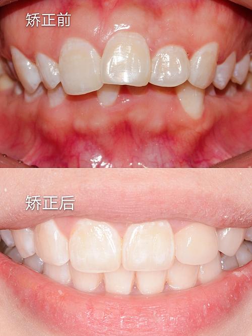成人正畸有用吗爱思特-图3