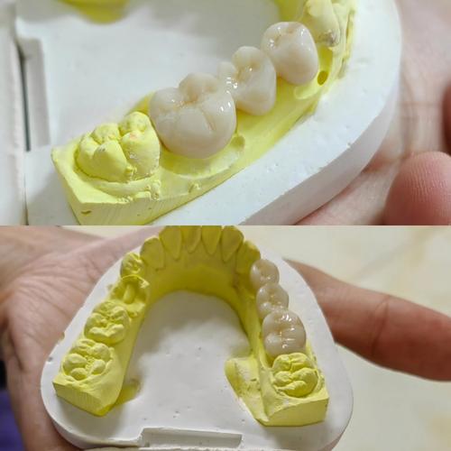 全瓷牙的制备方法视频-图2