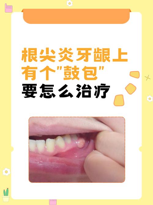 牙根发炎怎么办？治疗方法有哪些？-图3