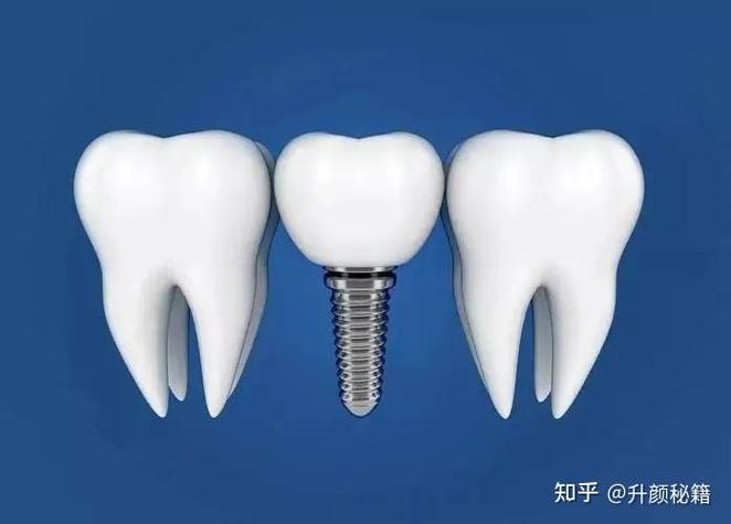 嘉兴种牙去哪儿好？靠谱医院怎么选？-图1