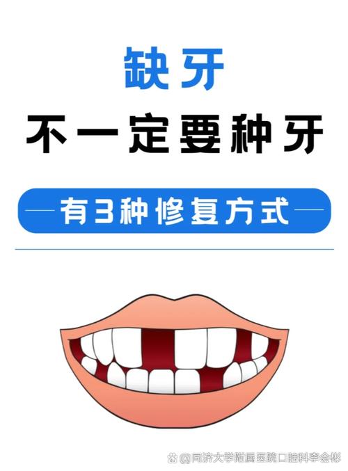 缺一颗牙需要种几颗-图2