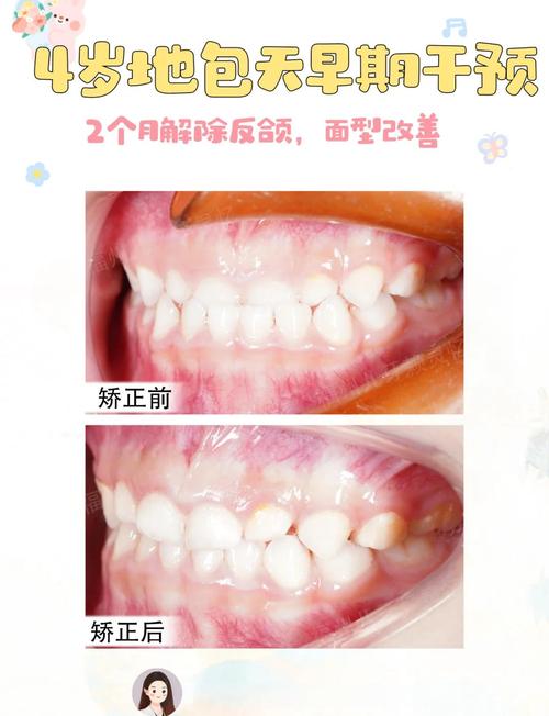 骨性反颌后正畸有用么-图3