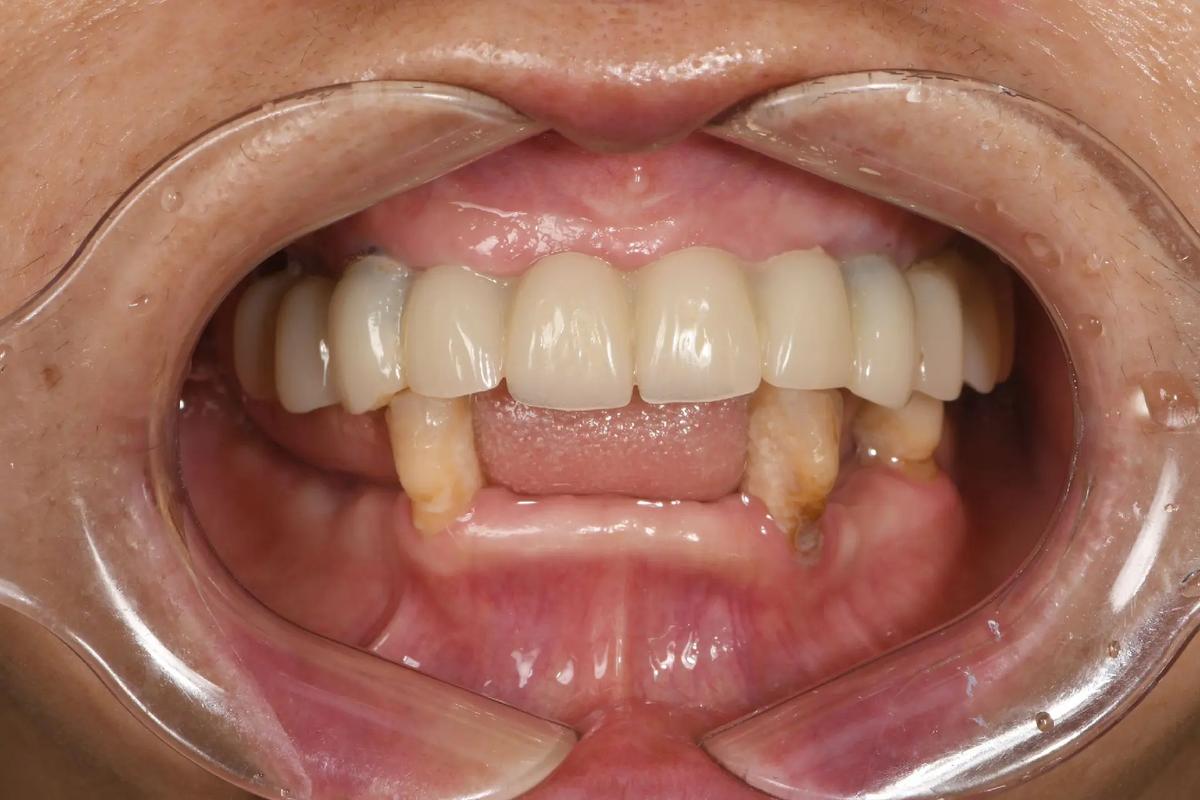 拜博口腔急拔急种牙-图3