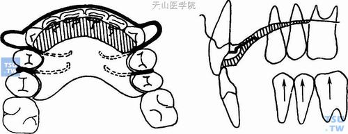 正畸双曲舌簧弯制方法-图3