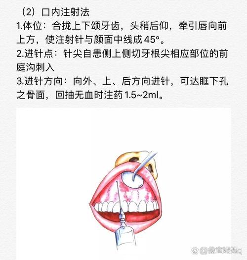 口腔局部麻醉的方法有-图1