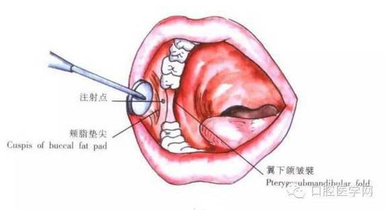 口腔局部麻醉的方法有-图2