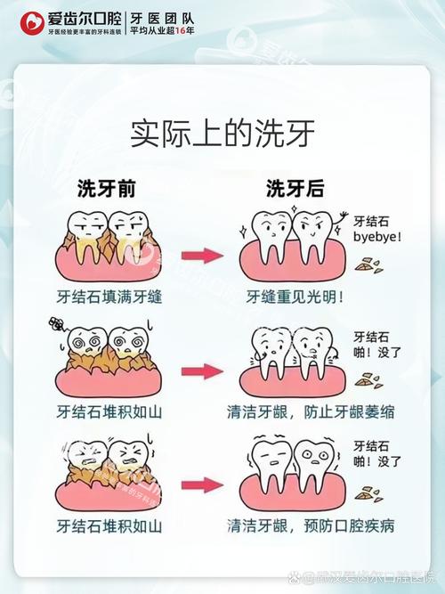 去除牙结石有哪些方法？专业牙医详解实用技巧与日常护理-图3
