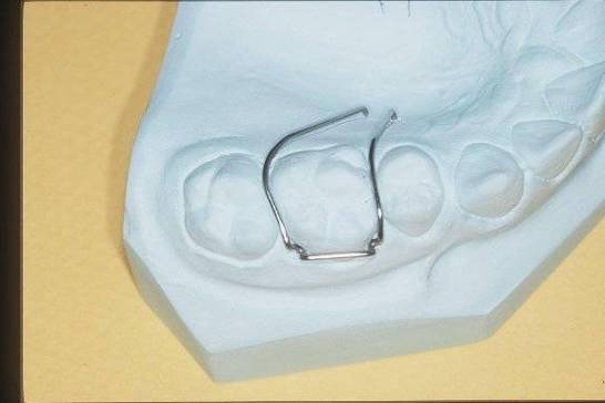 正畸单臂卡的弯制步骤-图1