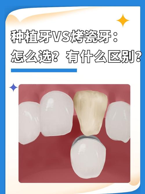 种牙与烤瓷牙的差别具体体现在哪？哪种更适合修复牙齿？-图1