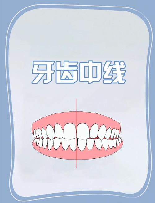 牙齿中线不齐有哪些调整方法？哪种最有效？-图3