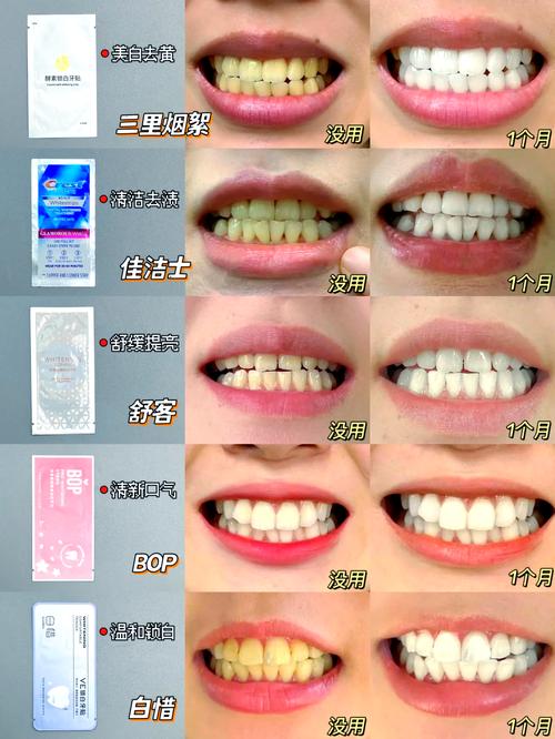 哪种美白牙齿的方法好-图3