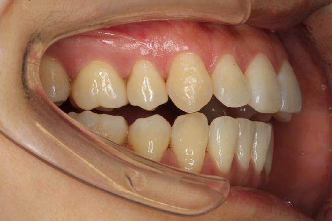 颞下颌关节盘前移正畸-图2