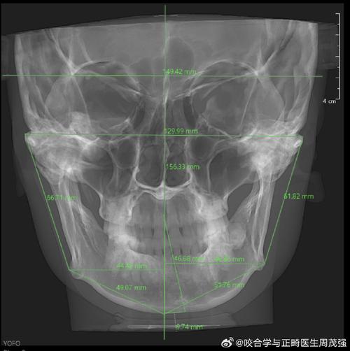 颞下颌关节盘前移正畸-图1