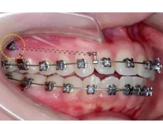 牙齿正畸支坑钉多少钱-图1