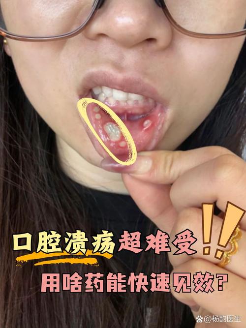 口腔溃疡最快好的方法-图2