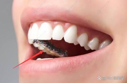 正畸带颊档的侧位拉钩为何能辅助牙齿精准移动？-图2