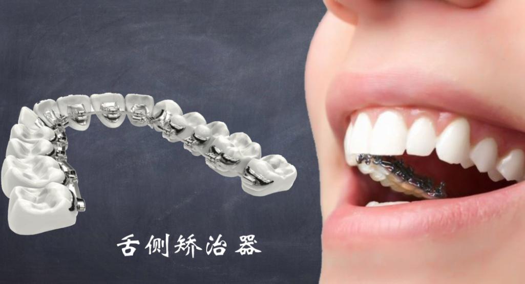 正畸带颊档的侧位拉钩为何能辅助牙齿精准移动？-图3