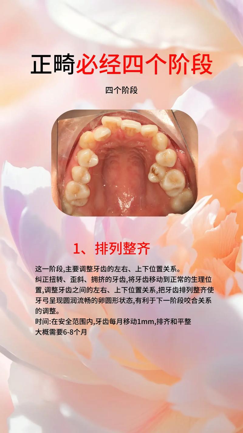 水平阻生智齿前移正畸-图2
