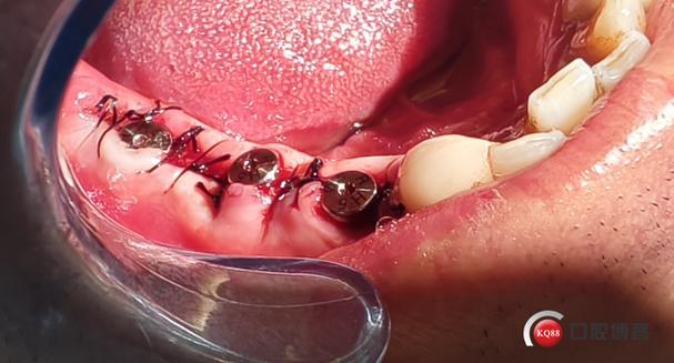 既拨即种牙是真的吗？专家解析即刻种植牙技术的真实性-图2