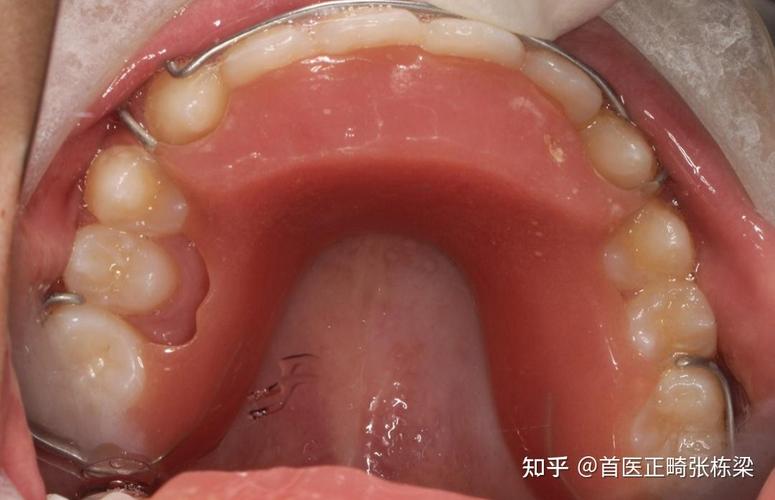 缺两个下颌侧切牙正畸能做吗？效果怎样？-图1
