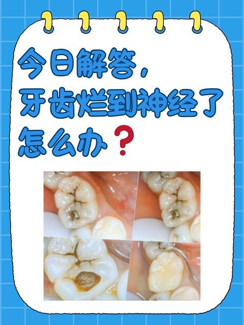 牙根炎症状与治疗方法-图3 牙根炎症状与治疗方法-图3