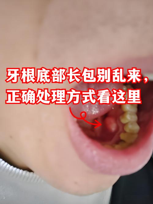 牙根炎症状与治疗方法-图2 牙根炎症状与治疗方法-图2