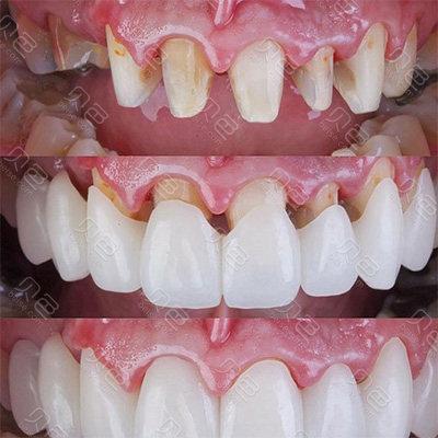 全瓷冠桥修复和种牙有何区别？牙齿缺失选哪个好？-图1