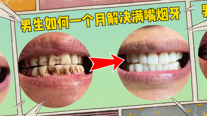 烟黄牙变白的简单方法-图1