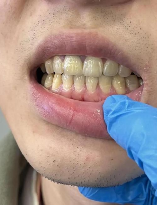 烟黄牙变白的简单方法-图2